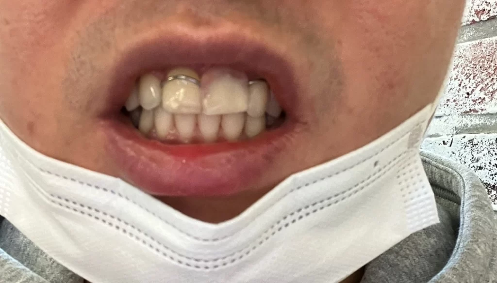 임플란트 뼈 이식  수술후 가짜 이빨 착용 후